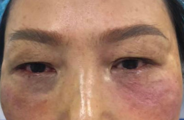 去眼袋手术