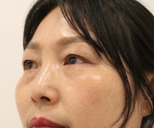 去眼袋手术