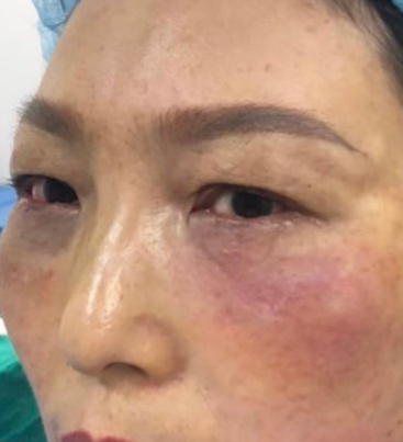 去眼袋手术