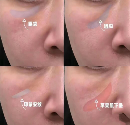 去眼袋手术