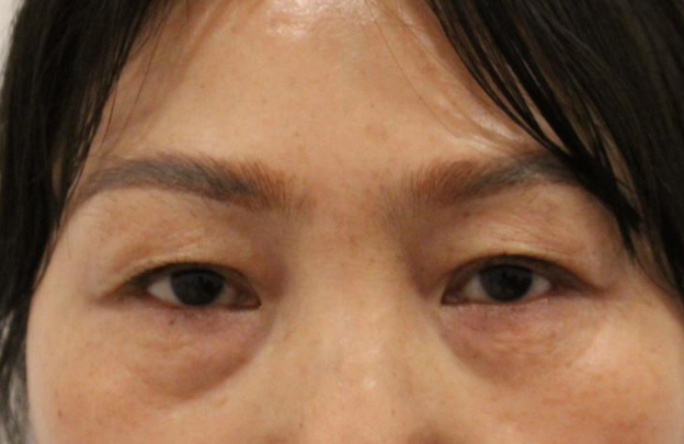 去眼袋手术
