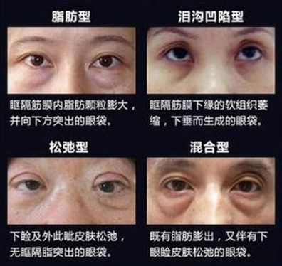 去眼袋手术