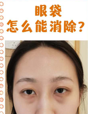 去眼袋手术