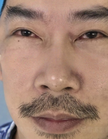 去眼袋手术