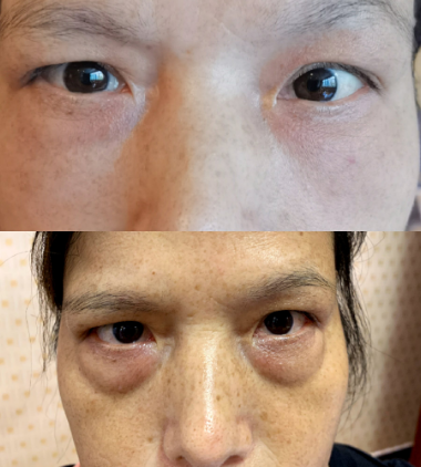 去眼袋手术
