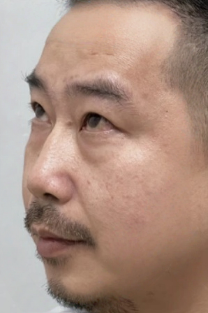 去眼袋手术