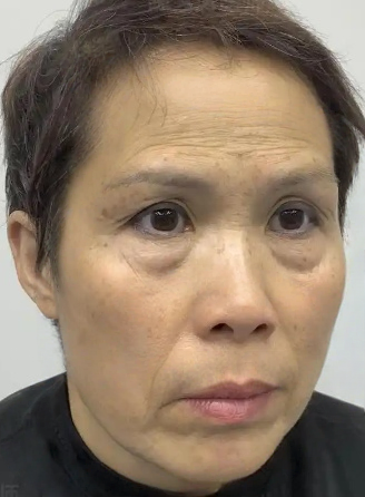 去眼袋手术