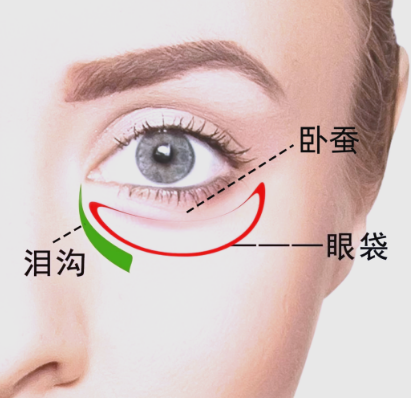 去眼袋手术