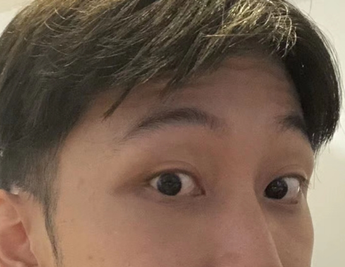 去眼袋手术