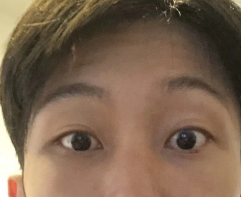 去眼袋手术