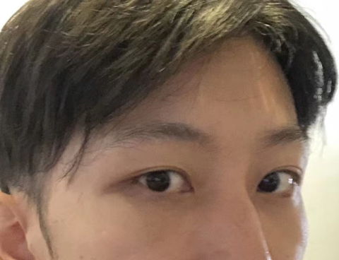 去眼袋手术