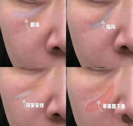 去眼袋手术