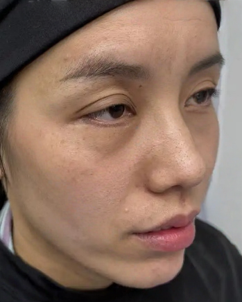 去眼袋手术