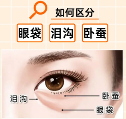 去眼袋手术