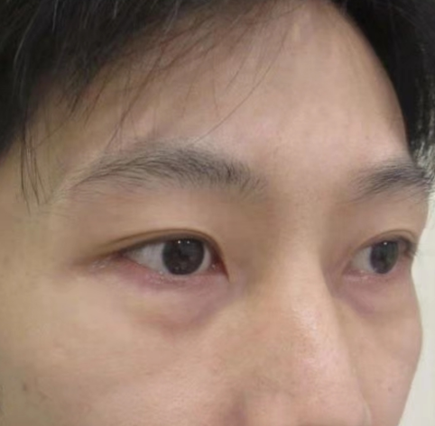 去眼袋手术