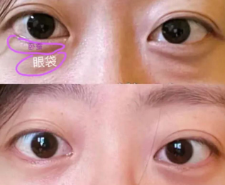 去眼袋手术