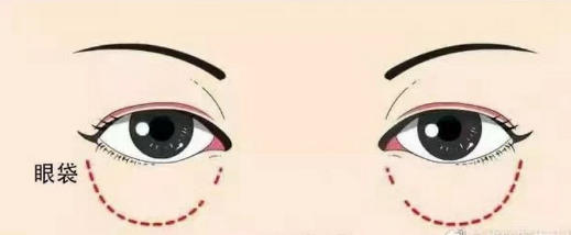 去眼袋手术