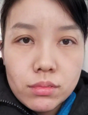 去眼袋手术