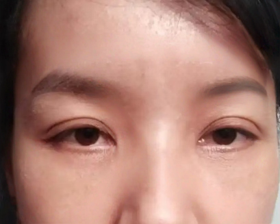 去眼袋手术