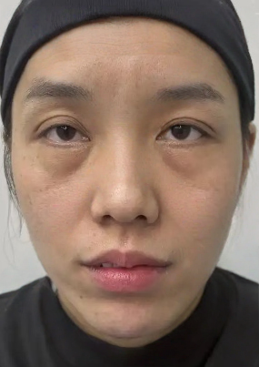 去眼袋手术