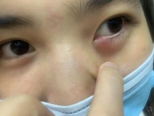 眼袋