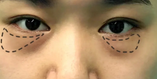 眼袋