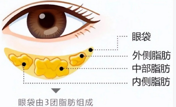眼袋
