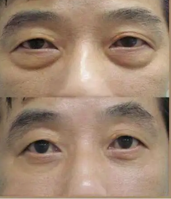 去眼袋手术