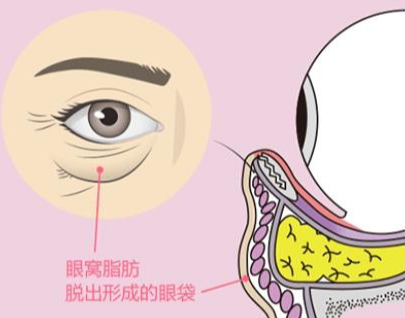 去眼袋手术
