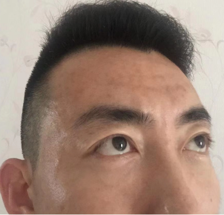 去眼袋手术