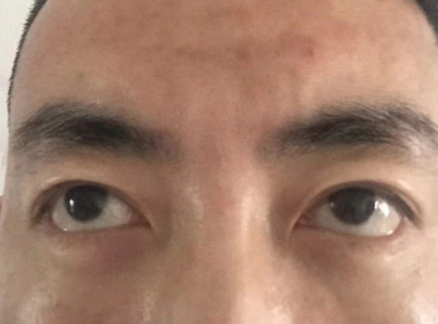 去眼袋手术