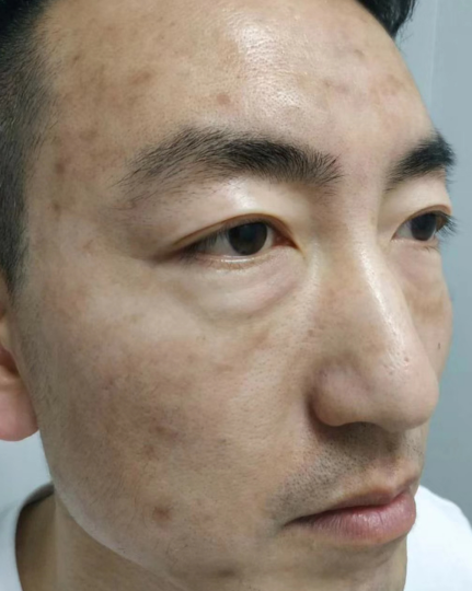 去眼袋手术