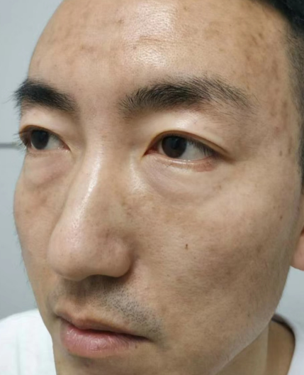 去眼袋手术