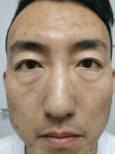 去眼袋手术