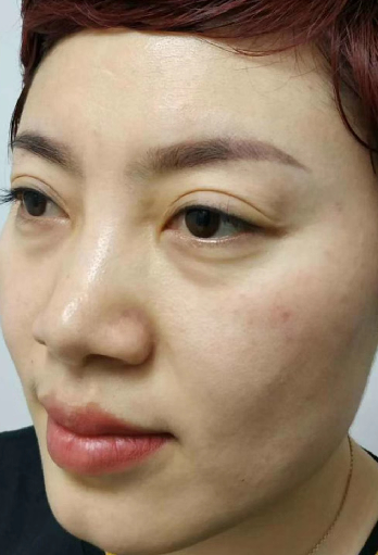 去眼袋手术
