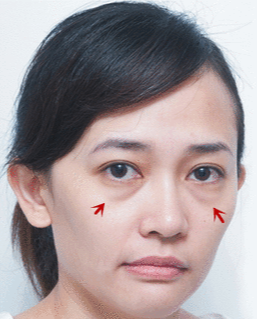 眼袋