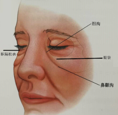 去眼袋手术