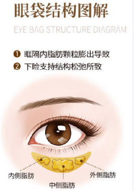 去眼袋手术