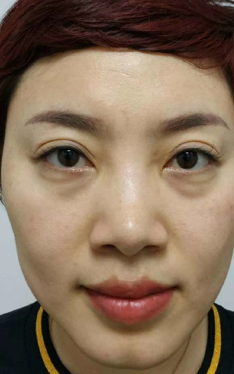 去眼袋手术