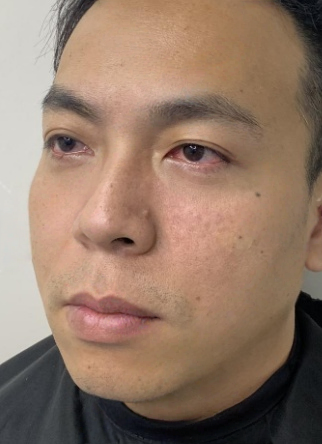 去眼袋手术