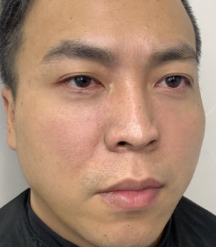去眼袋手术