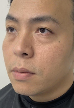 去眼袋手术
