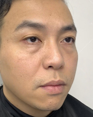 去眼袋手术
