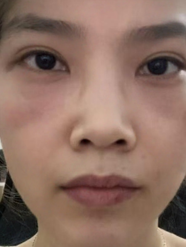 去眼袋手术