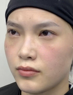 去眼袋手术