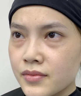 去眼袋手术