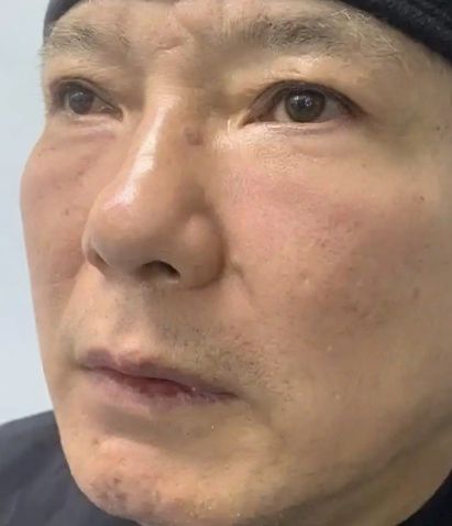 去眼袋手术