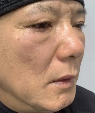 去眼袋手术