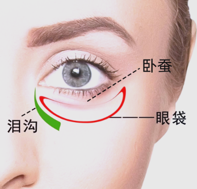 去眼袋手术