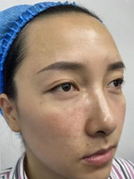 去眼袋手术